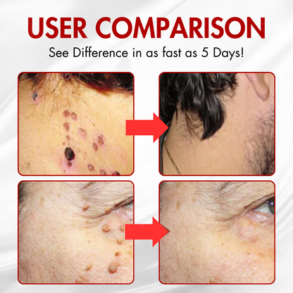 ✨AEXZR® Nano-Microdart Skin Tag & Spot Corrector Patches -🩹 Dual-Release Tech, Painless Removal🌿